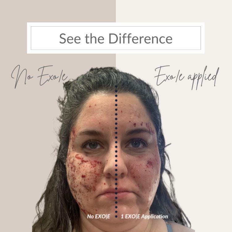 EXOE Before and After Photo by Ona Skincare in Nashville, TN