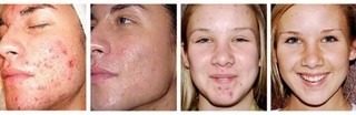 Diamond Dermal Infusion results on teens