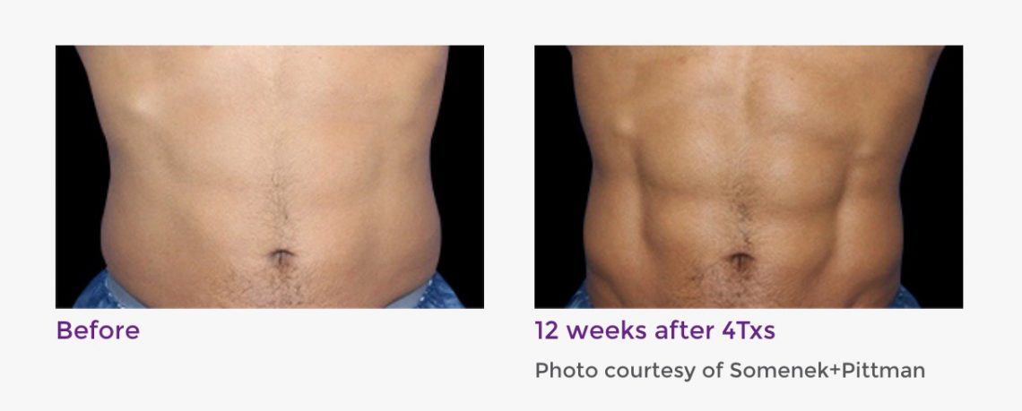 truSculpt Flex before and after 