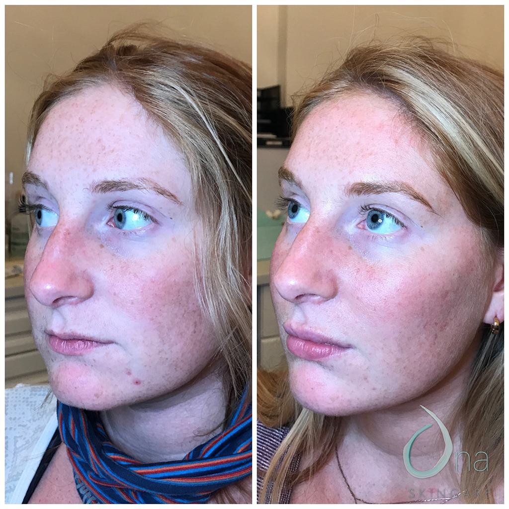 Chin cheek filler before and after photo by Ona Skincare in Nashville TN