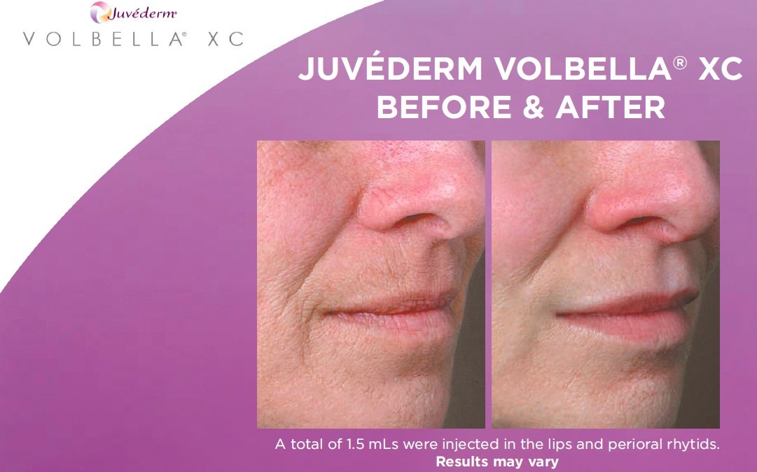 JUVEDERM VOLBELLA Before and After Photos