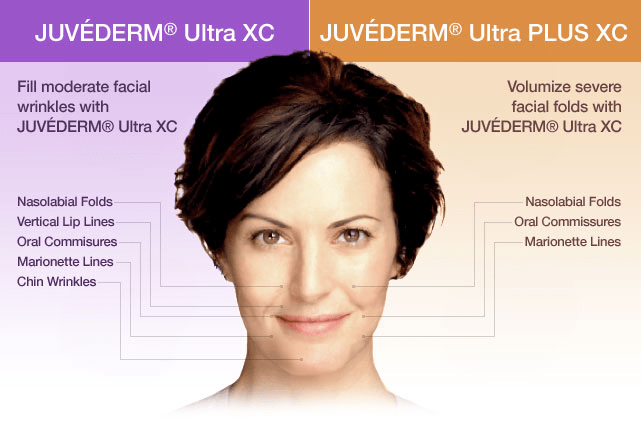 Juvederm Ultra XC and Juvederm Ultra PLUS XC treatment areas