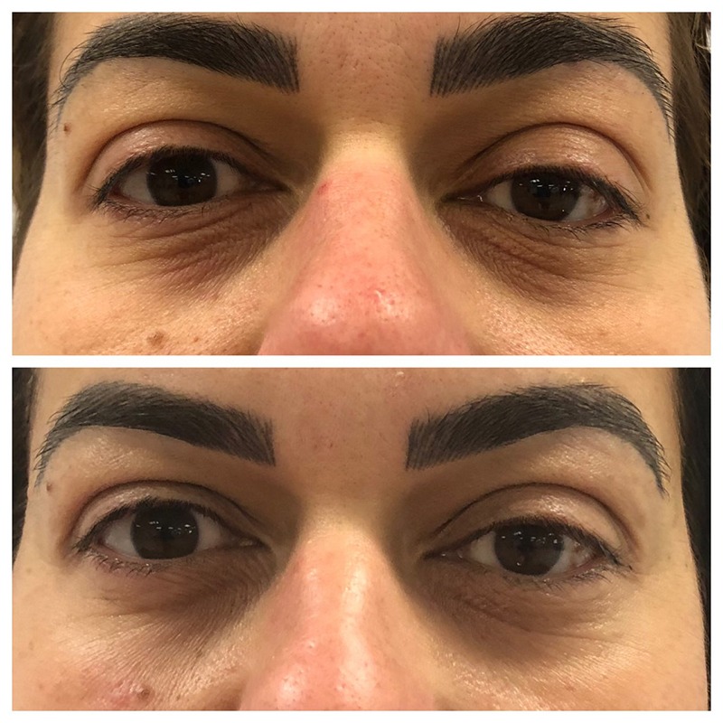 PRX Derm Perfexion Skin Rejuvenation Before and After