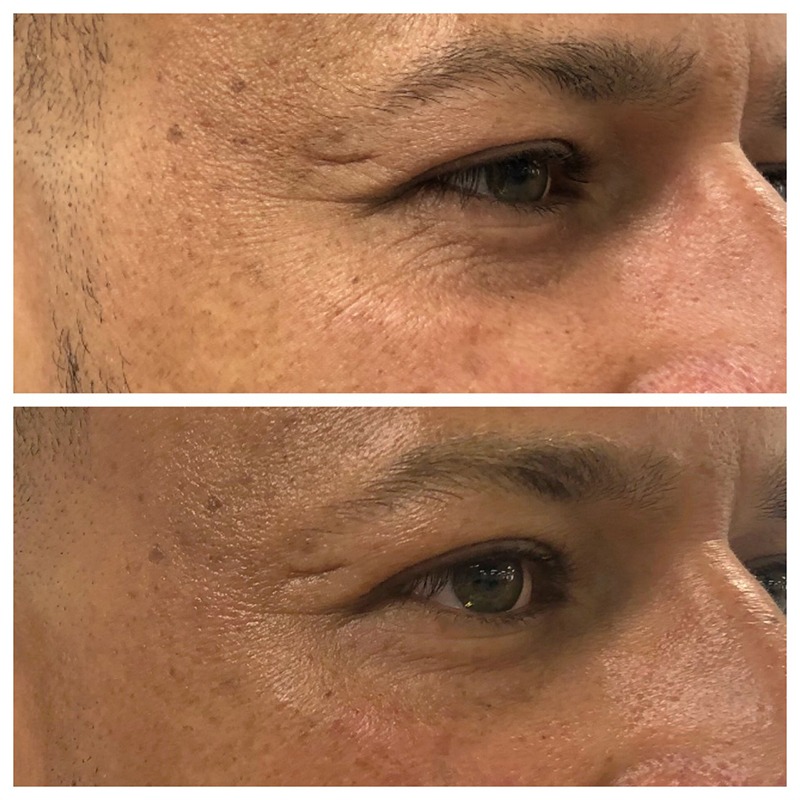PRX Derm Perfexion Skin Rejuvenation Before and After