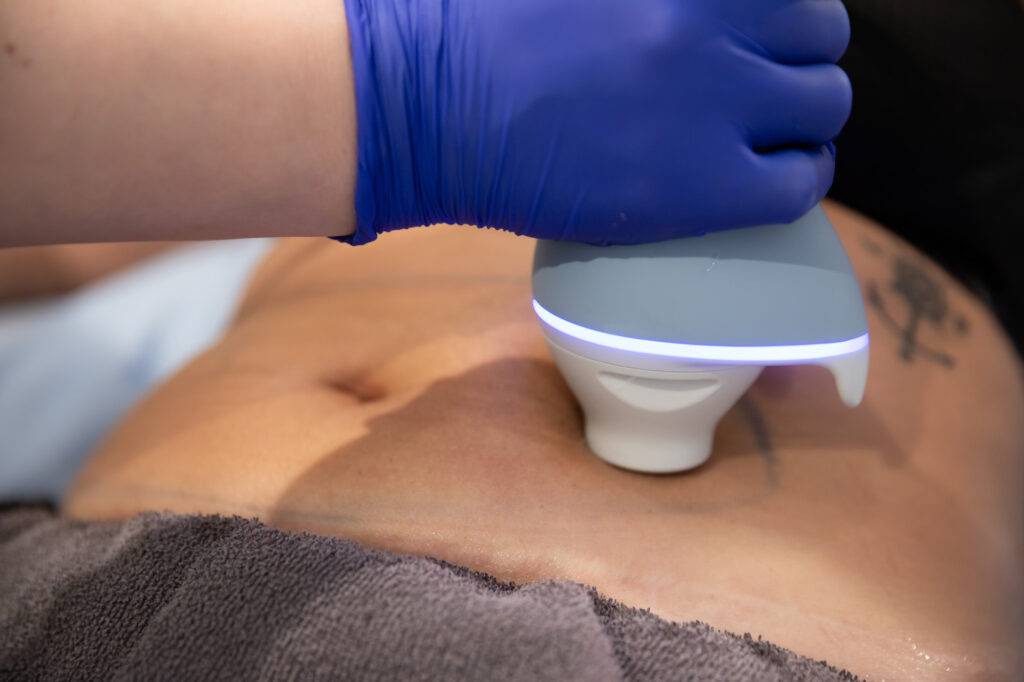Close up of CoolSculpting on a patient's stomach, which they boost with peptides in Nashville.