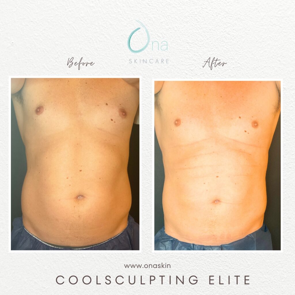 A man's torso before and after body contouring in Belle Meade