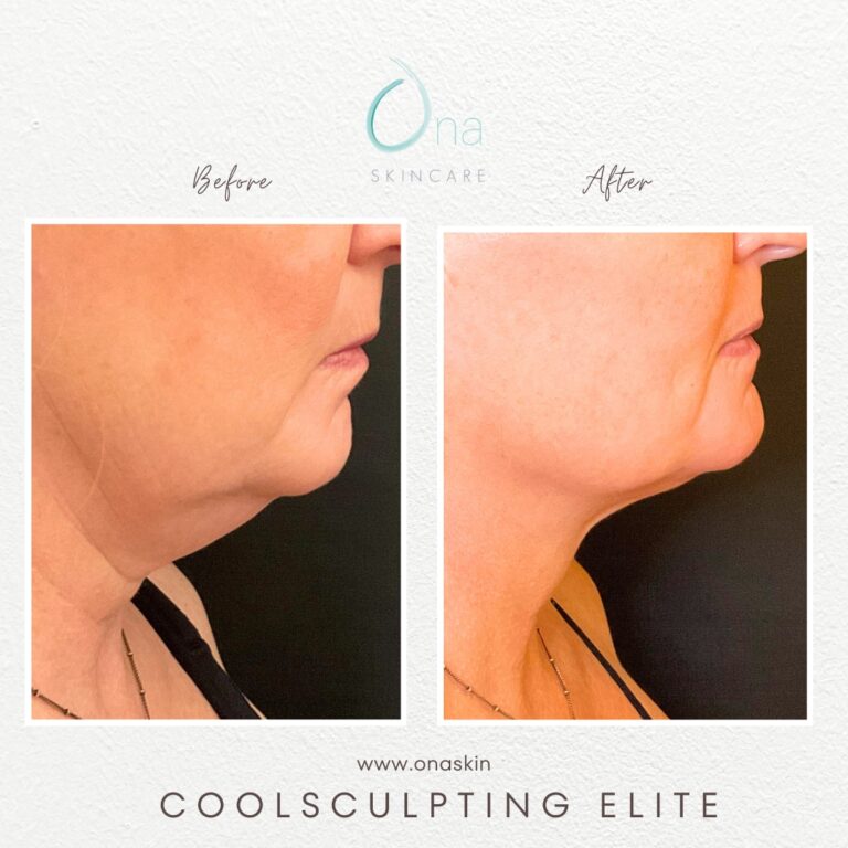 A woman's neck before and after CoolSculpting near Belle Meade