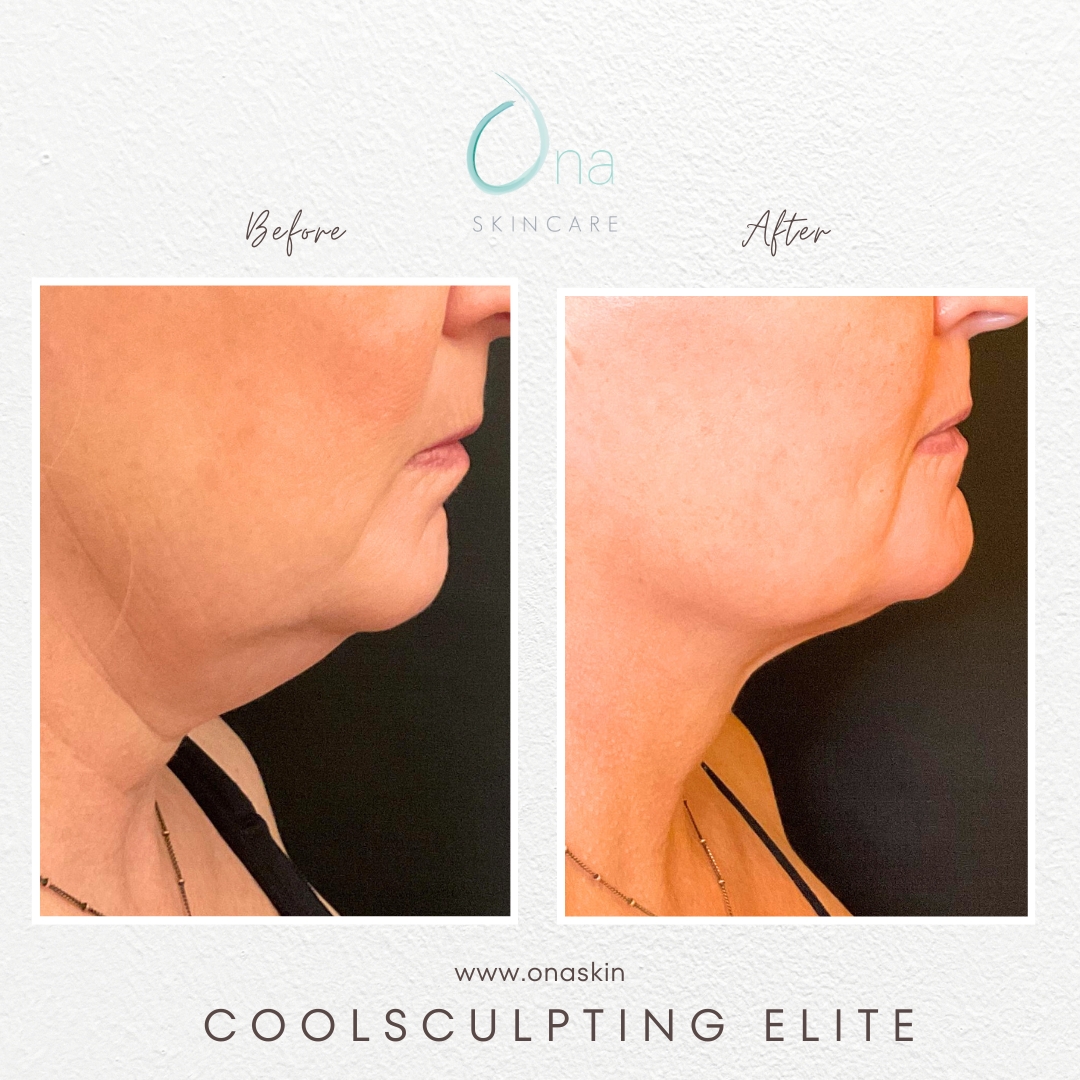 A woman's neck before and after CoolSculpting near Belle Meade