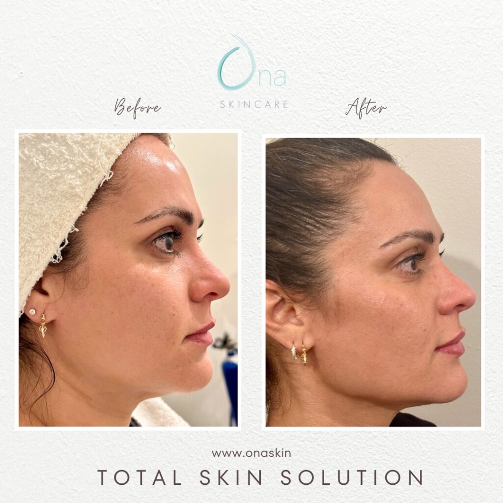 Before and after a woman received the Total Skin Solution treatment in East Nashville