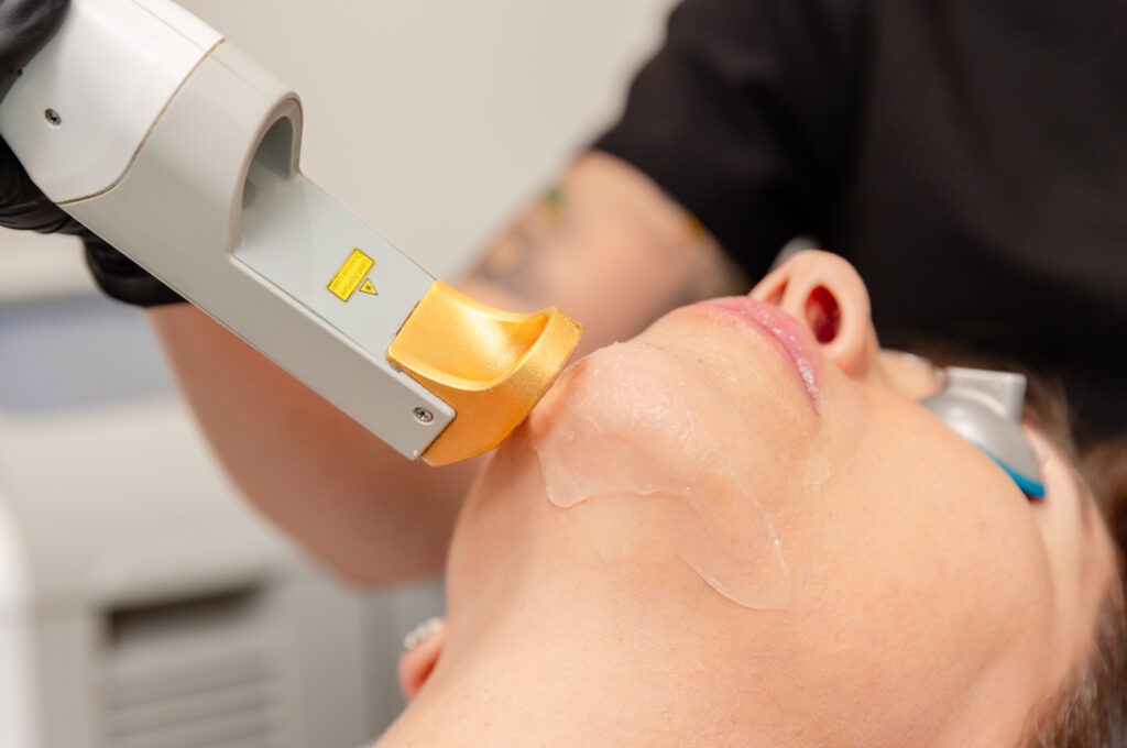 Close up of a woman getting facial hair removal at a skin clinic in Nashville.