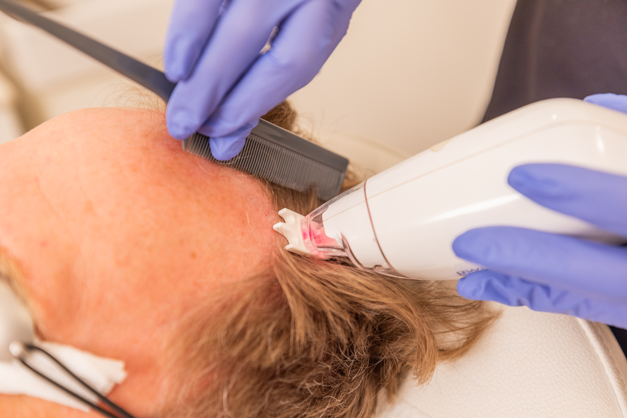 Close up of a treatment for hair restoration near Belle Meade.