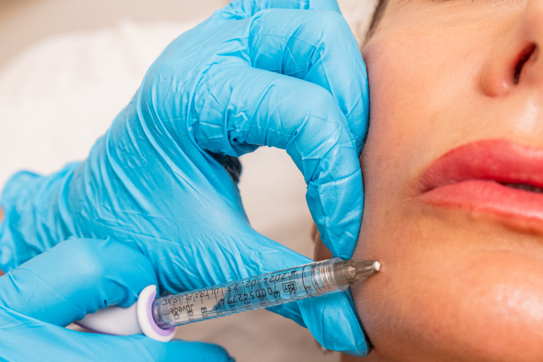 An Ona practitioner skillfully places a patient's jowl filler near Brentwood.